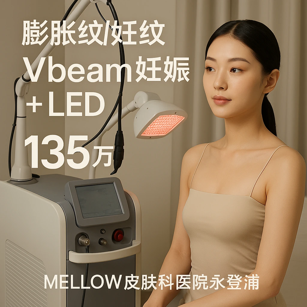 Vbeam 妊娠纹 + LED